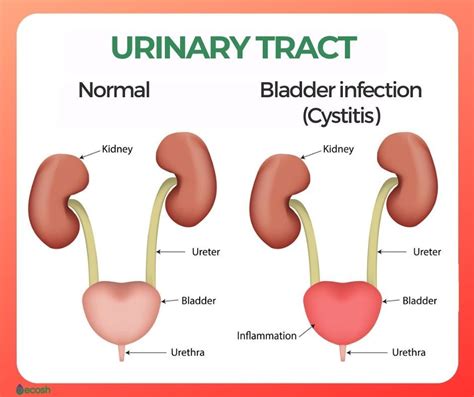 Cystitis: Bladder Pain, Inflammation Causes, Relief 